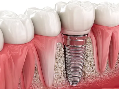 インプラントのイメージ